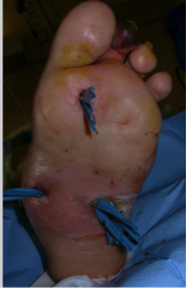 Drainage d'une cellulite sur pied neuropathie (avant/après)