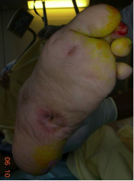 Drainage d'une cellulite sur pied neuropathie (avant/après)