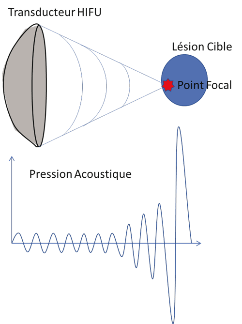 2) Les HIFU comme alternative a la chirurgie dans l'Endometriose profonde CA PHILIP