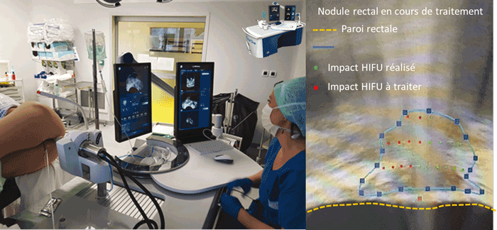 2) Les HIFU alternative a la chirurgie dans l'Endometriose profonde CA PHILIP 1