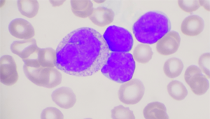 Leucémie Lymphoïde Chronique : Ãtat de l'art