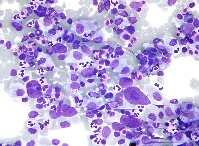 Lymphome de Hodgkin : Modernisation des stratégies thérapeuthiques 