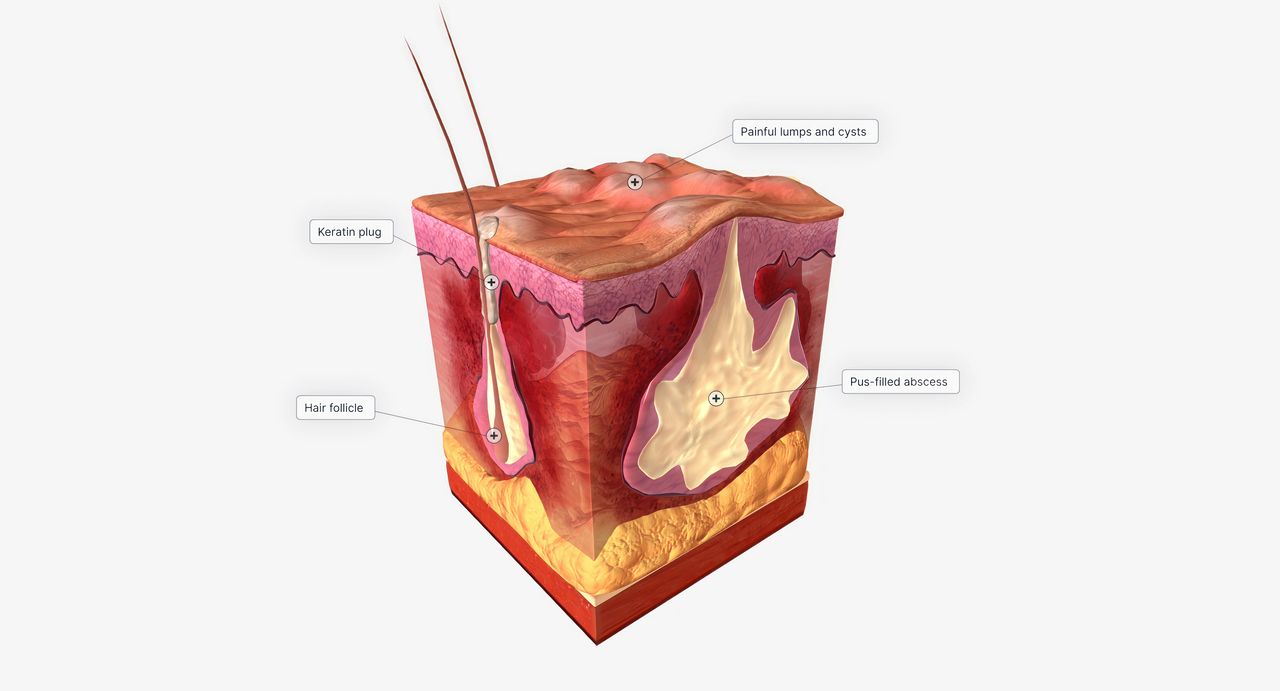 Illustration medicale - Actualités dans la maladie de Verneuil