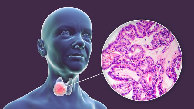 Cancers endocriniens et neuroendocriniens : la révolution des thérapies ciblées ? 