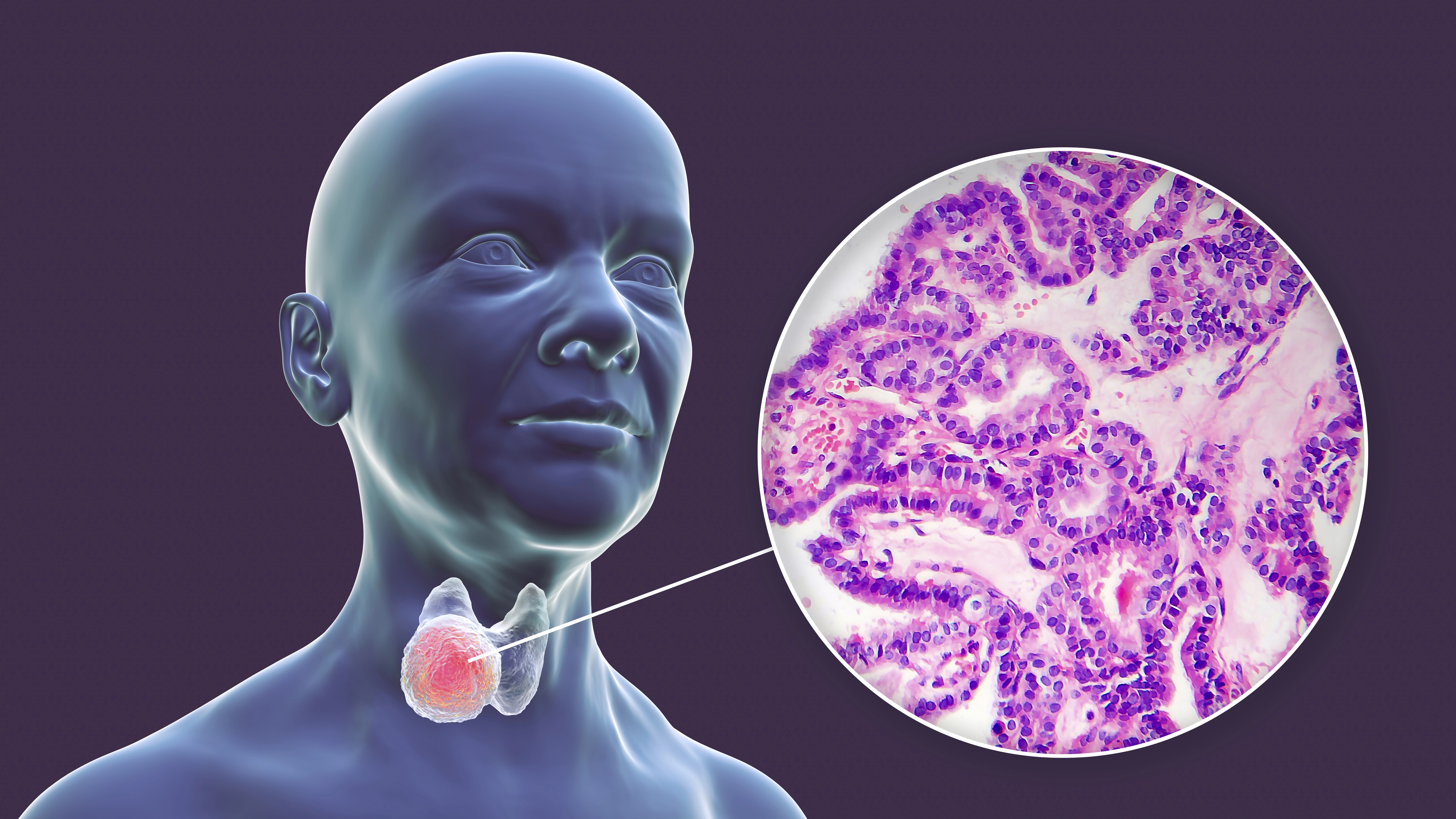 Cancers endocriniens et neuroendocriniens