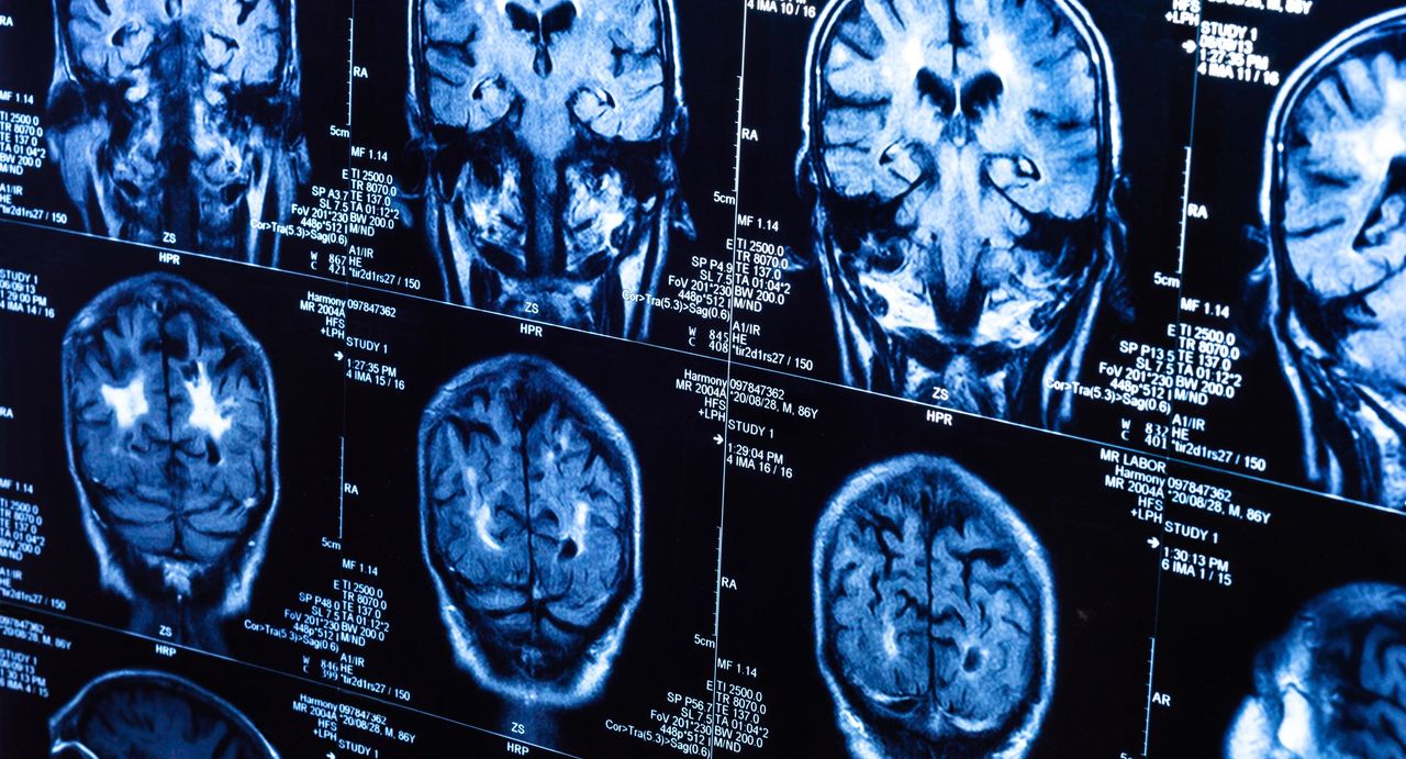 Ãdito - La neurologie : une spécialité en plein renouveau !
