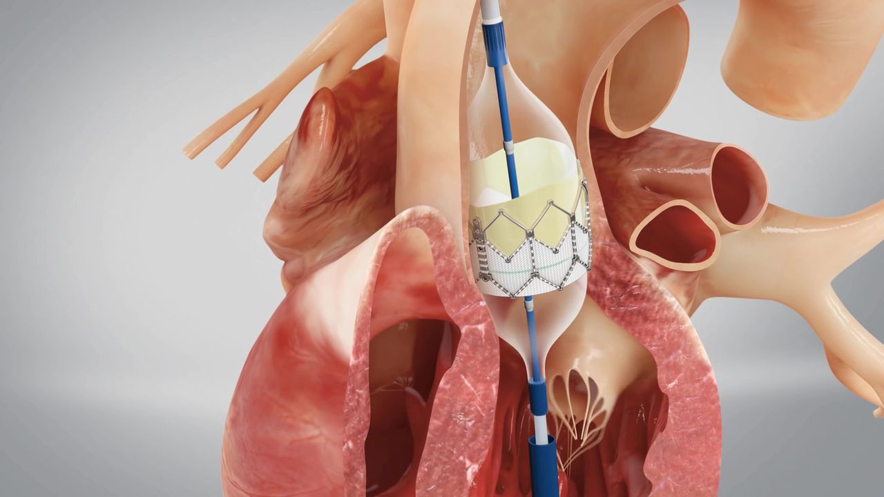 Illustration medicale - Sténose aortique : TAVI ou chirurgie ?